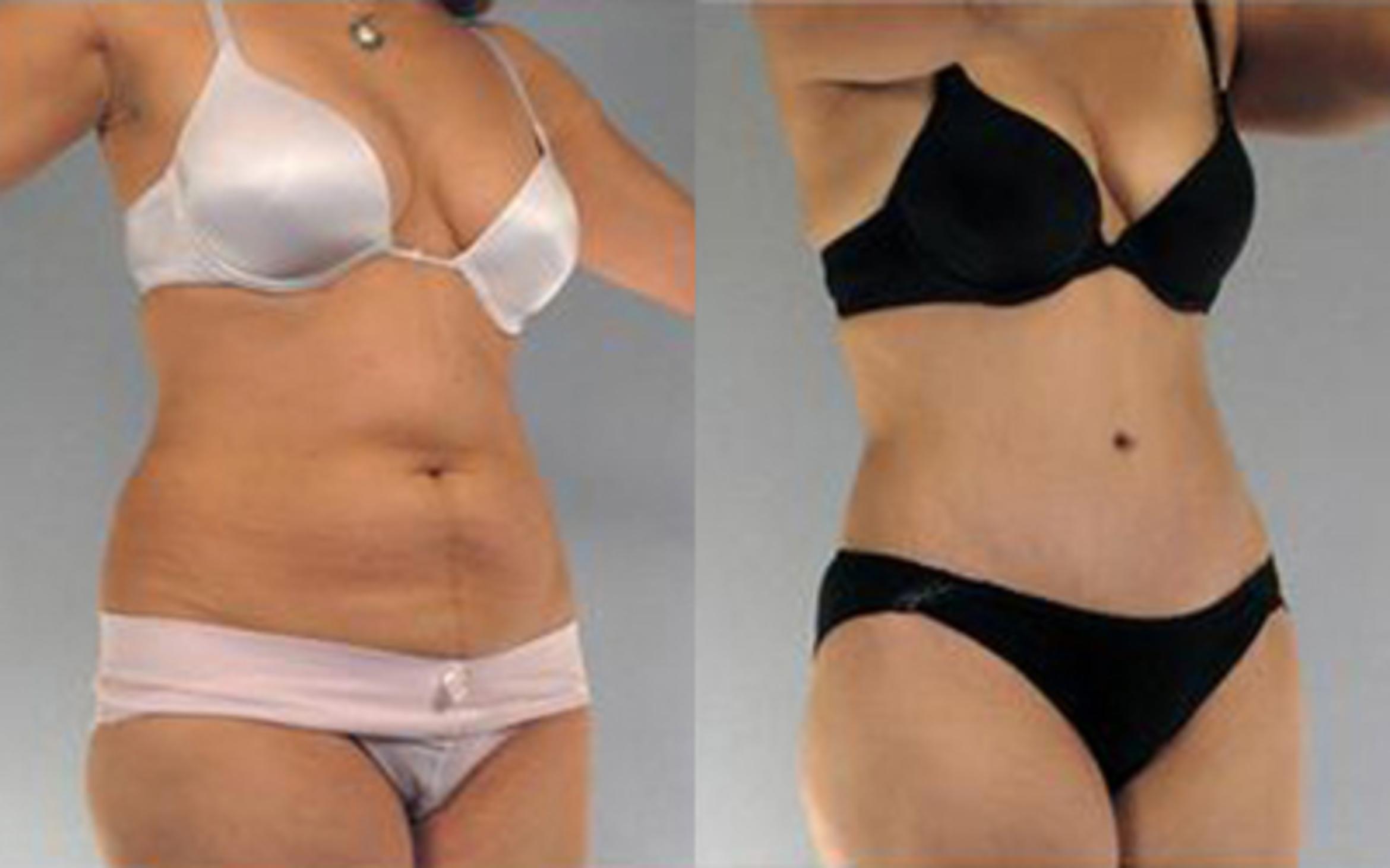 Before & After Tummy Tuck Case 14 View 2 View in Houston, TX