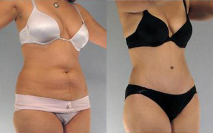 Before & After Tummy Tuck Case 14 View 2 View in Houston, TX