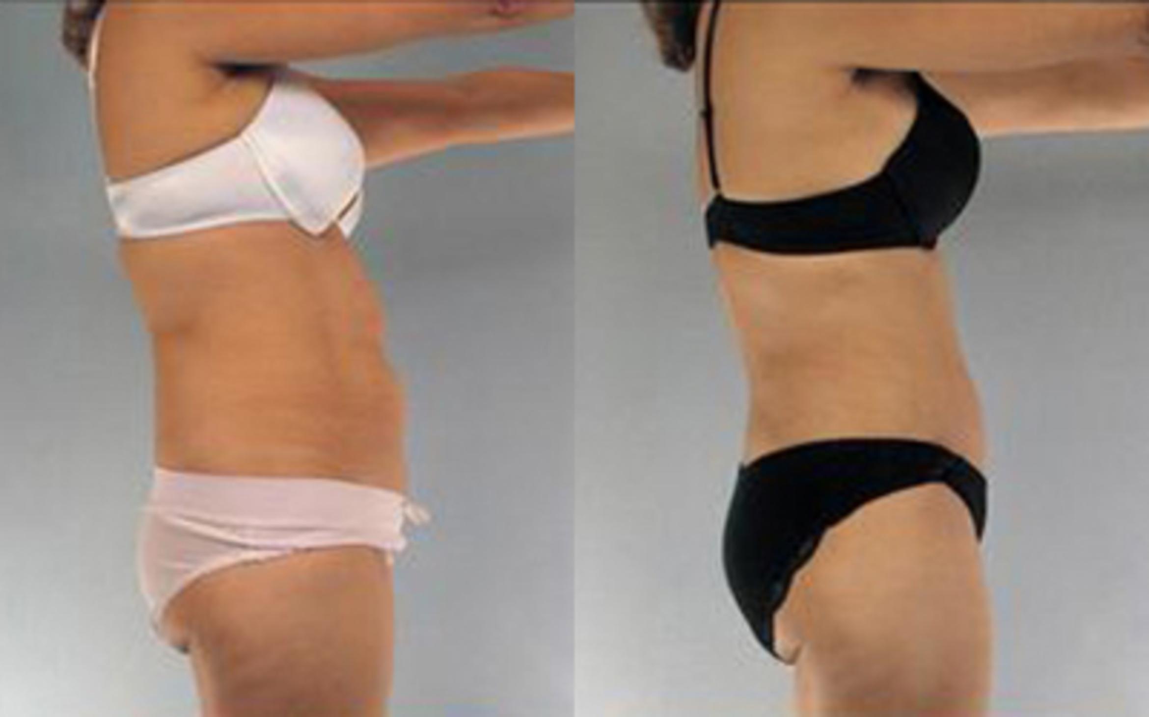 Before & After Tummy Tuck Case 14 View 3 View in Houston, TX