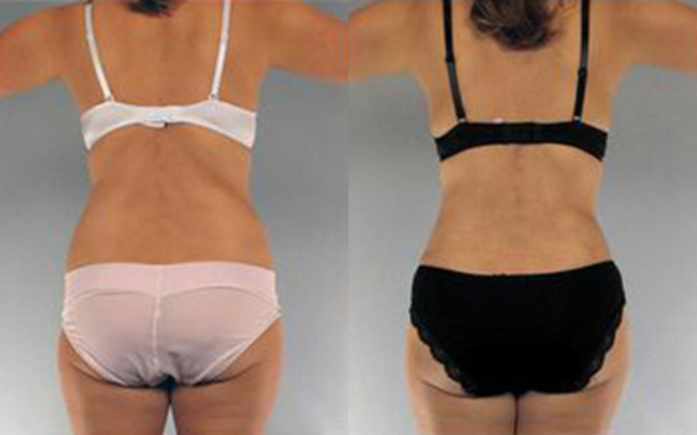 Before & After Tummy Tuck Case 14 View 4 View in Houston, TX