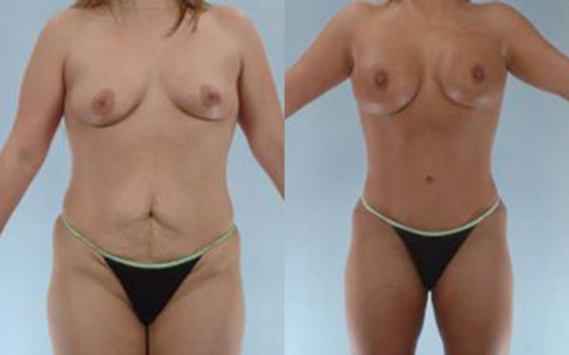 Before & After Tummy Tuck Case 15 View 1 View in Houston, TX