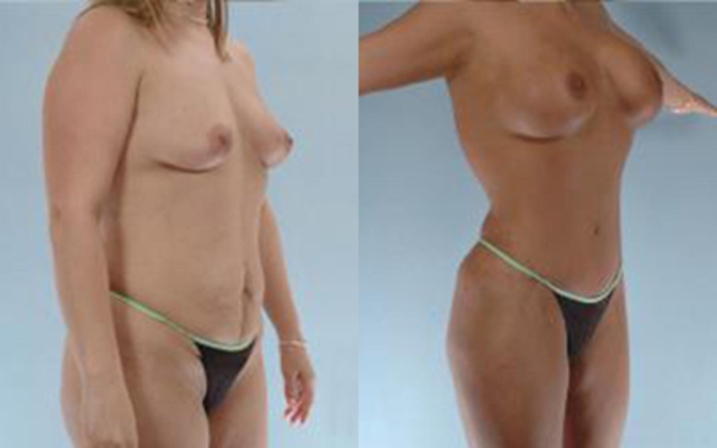 Before & After Tummy Tuck Case 15 View 2 View in Houston, TX