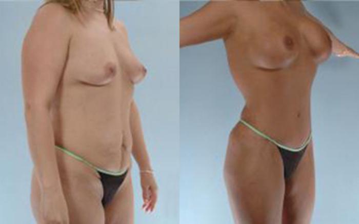 Before & After Tummy Tuck Case 15 View 2 View in Houston, TX
