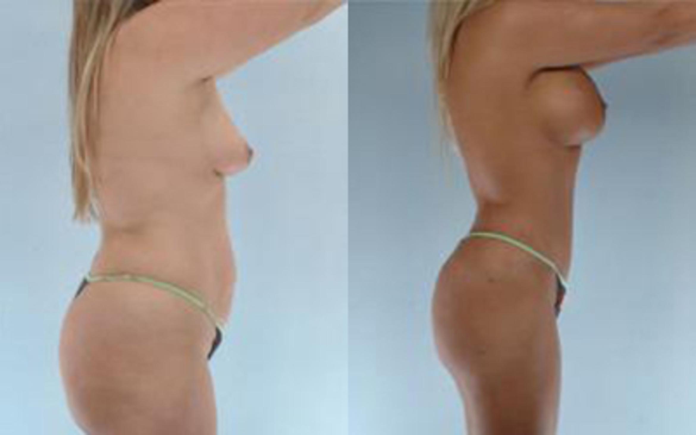 Before & After Tummy Tuck Case 15 View 3 View in Houston, TX