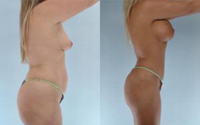 Before & After Tummy Tuck Case 15 View 3 View in Houston, TX