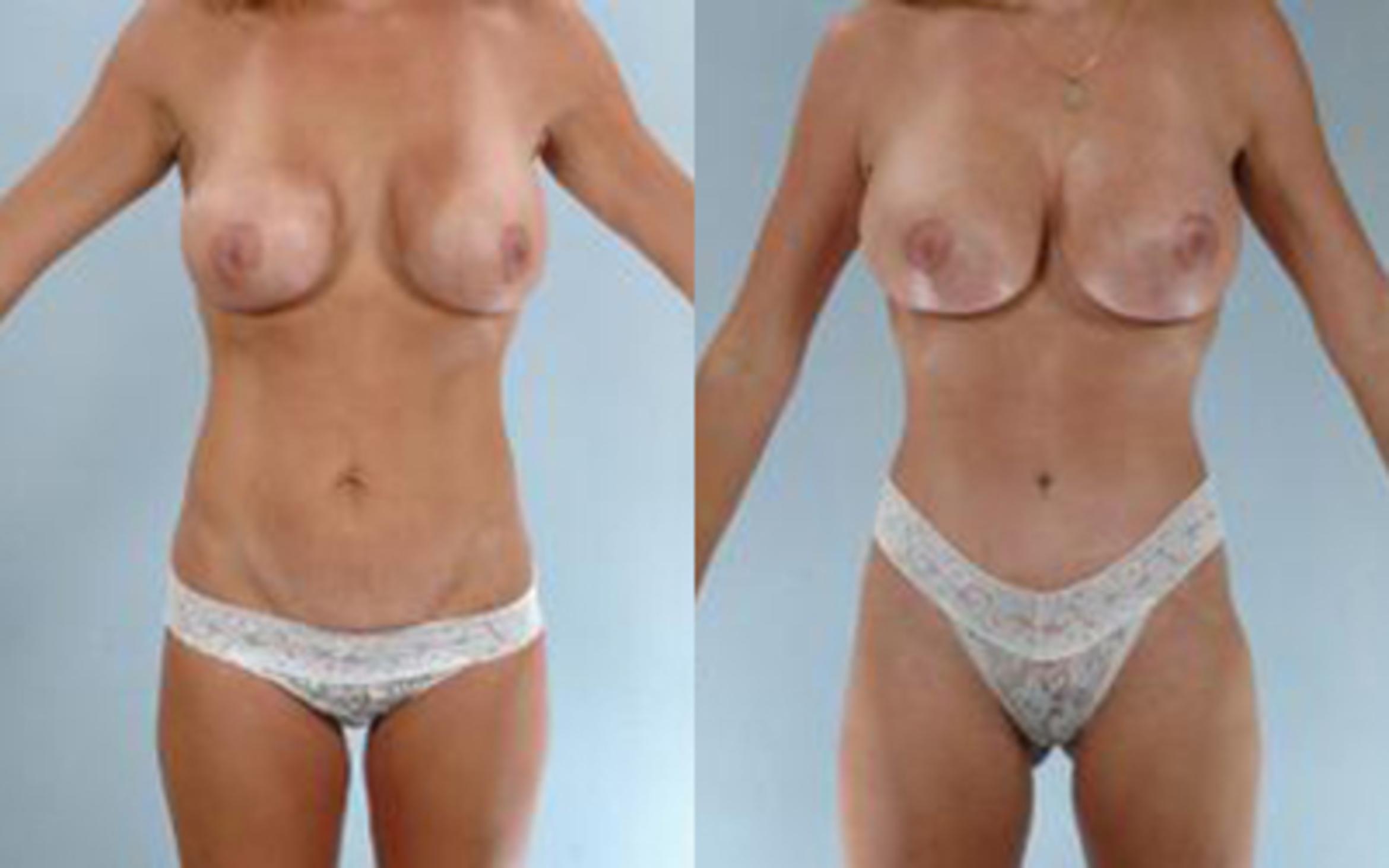 Before & After Tummy Tuck Case 16 View 1 View in Houston, TX
