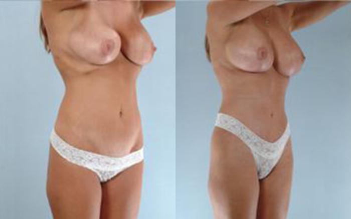 Before & After Tummy Tuck Case 16 View 2 View in Houston, TX