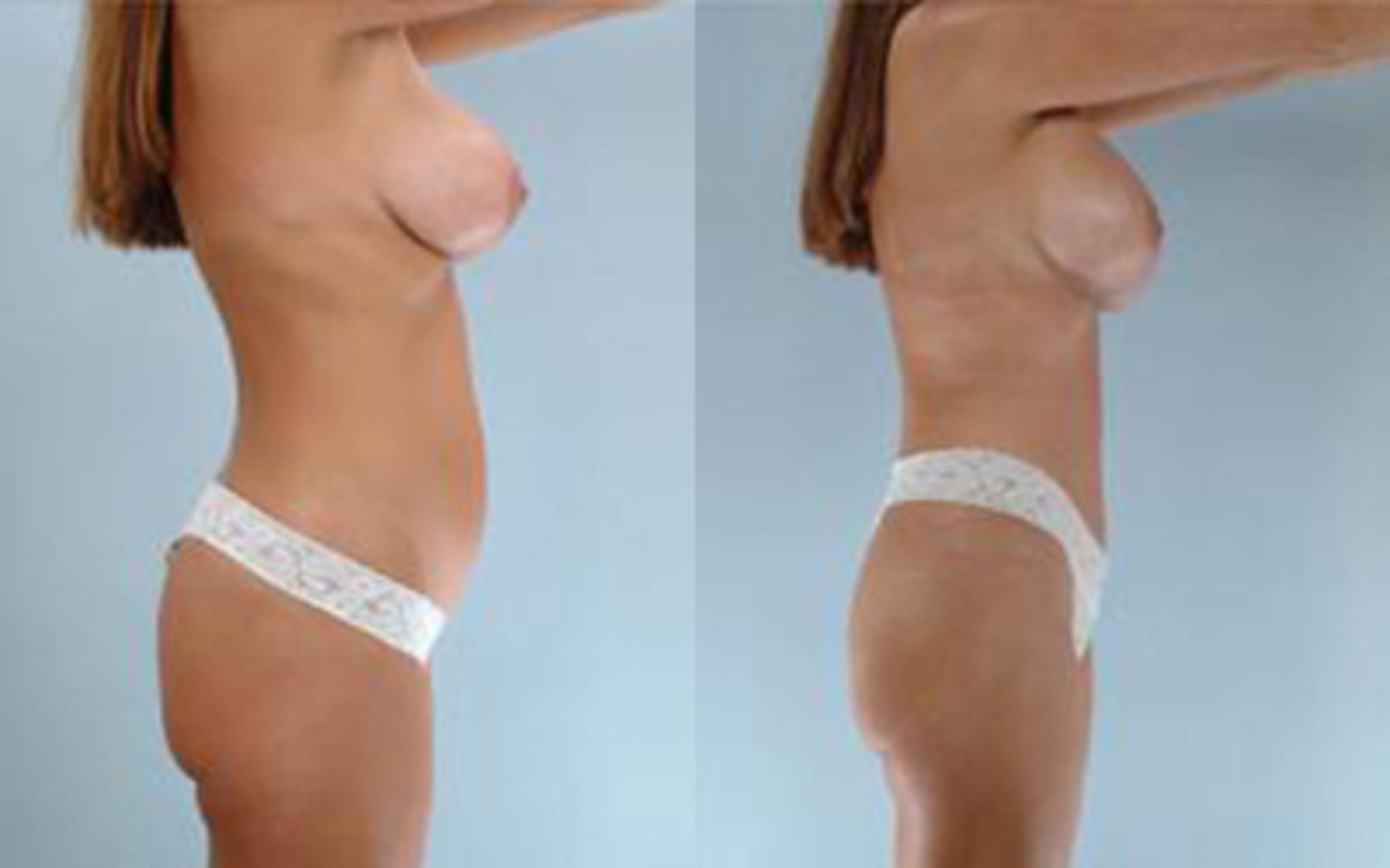 Before & After Tummy Tuck Case 16 View 3 View in Houston, TX