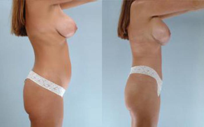 Before & After Tummy Tuck Case 16 View 3 View in Houston, TX