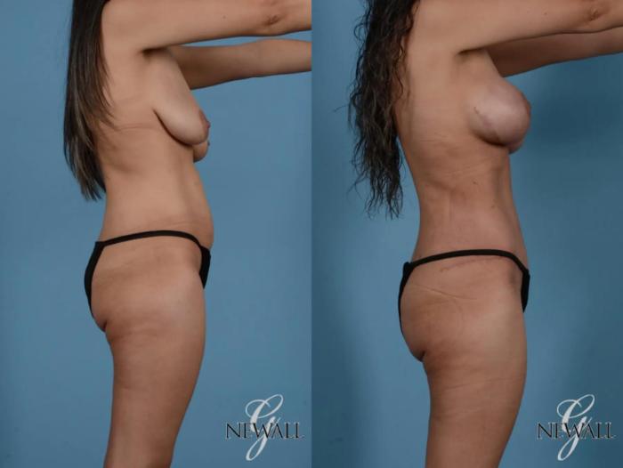 Before & After Tummy Tuck Case 16977 View 3 View in Houston, TX
