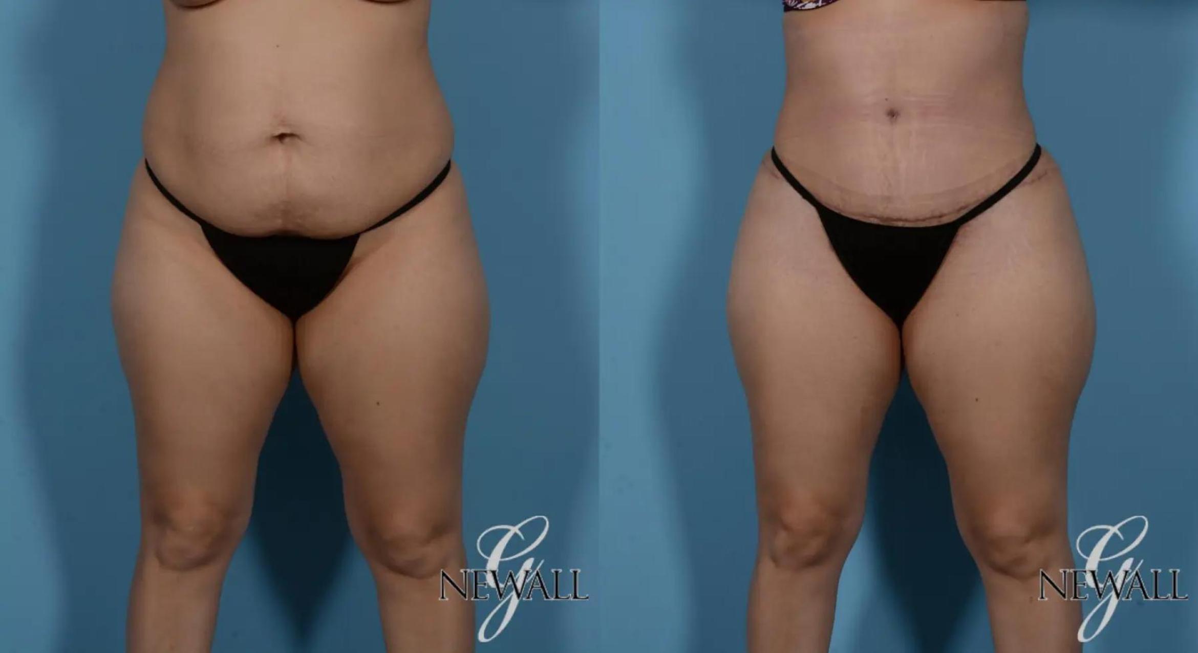 Before & After Tummy Tuck Case 16984 View 1 View in Houston, TX