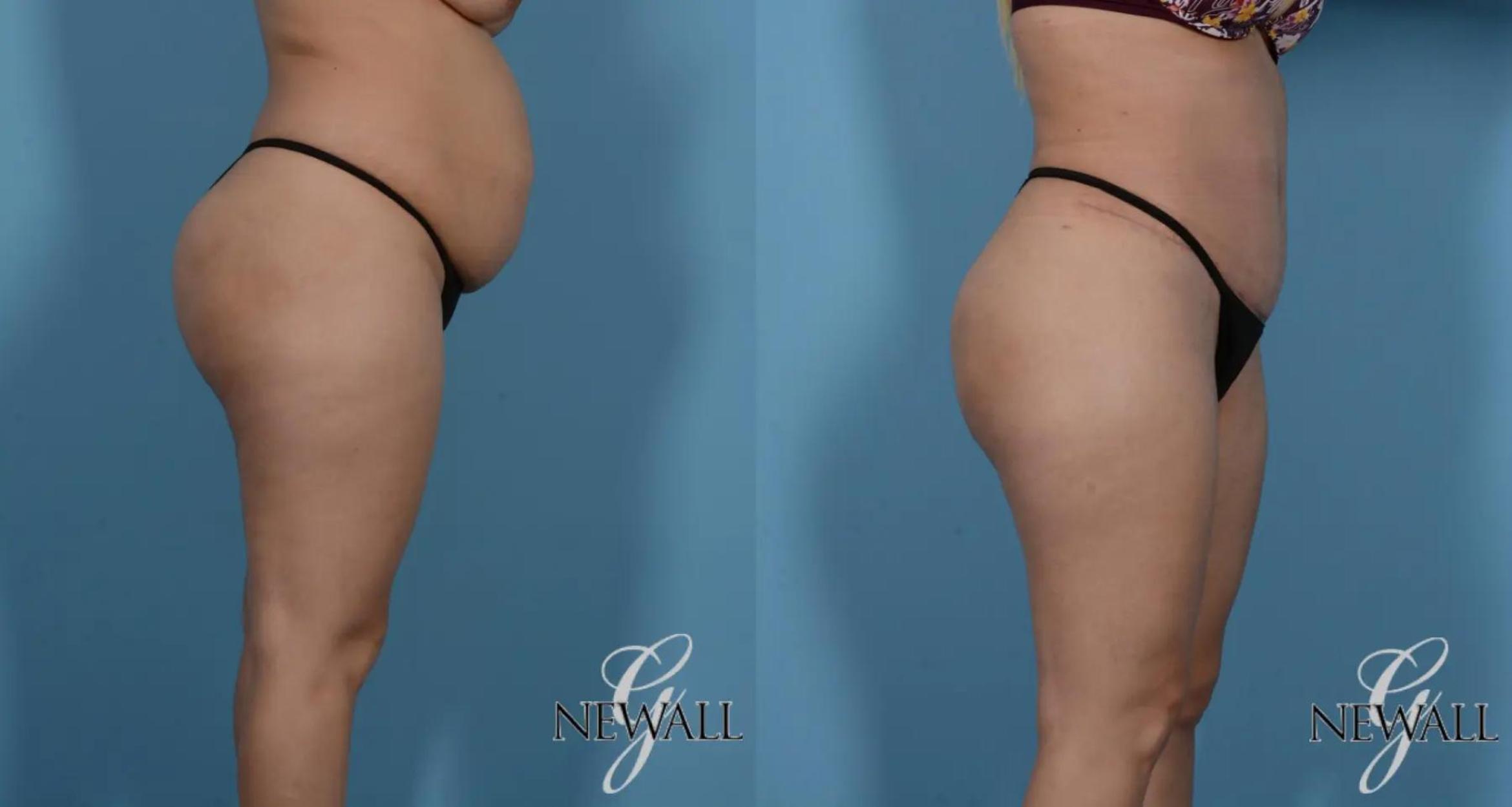 Before & After Tummy Tuck Case 16984 View 3 View in Houston, TX