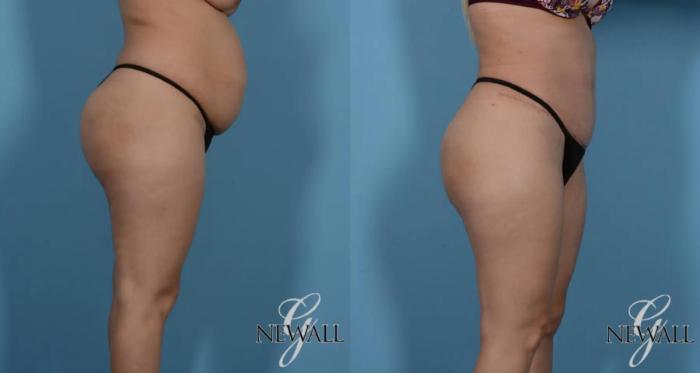 Before & After Tummy Tuck Case 16984 View 3 View in Houston, TX