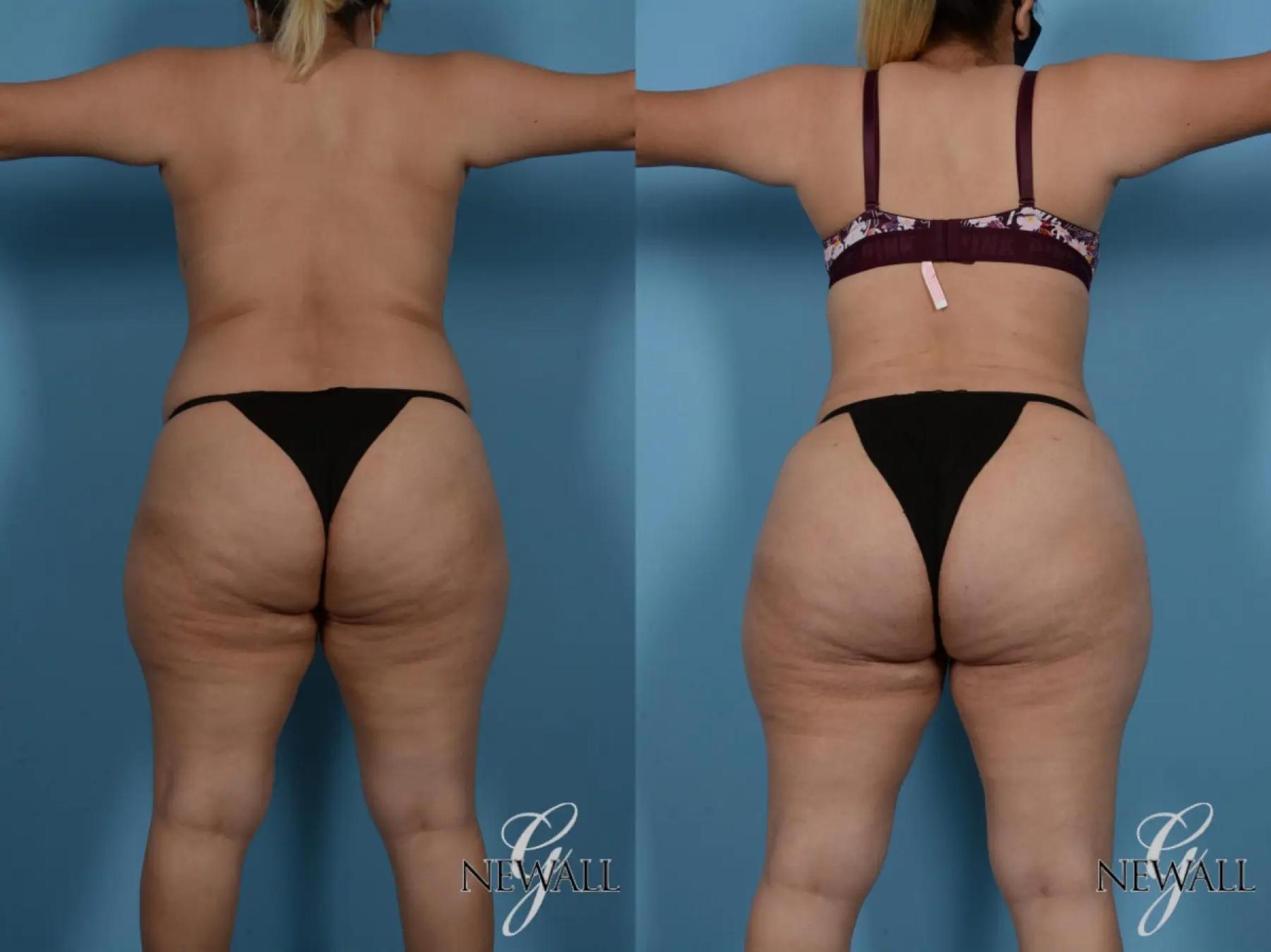 Before & After Tummy Tuck Case 16984 View 4 View in Houston, TX