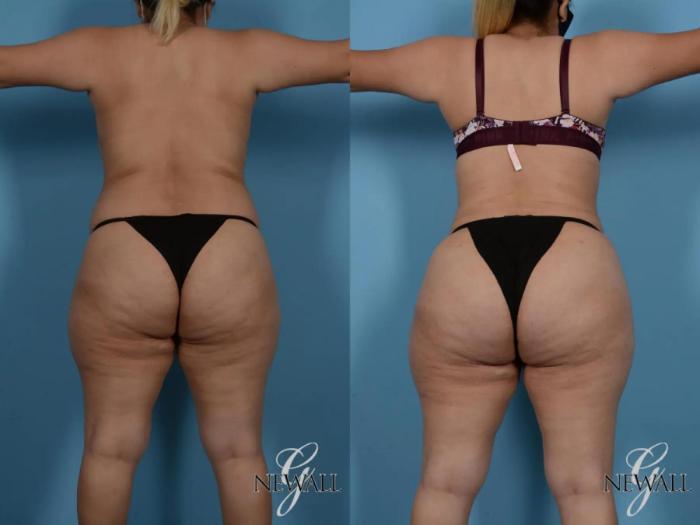 Before & After Tummy Tuck Case 16984 View 4 View in Houston, TX