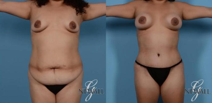Before & After Tummy Tuck Case 16985 View 1 View in Houston, TX
