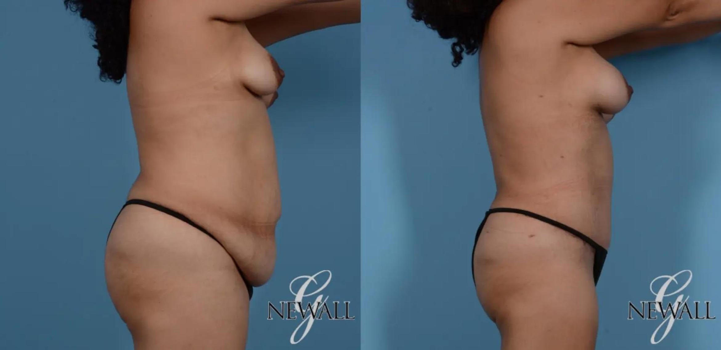 Before & After Tummy Tuck Case 16985 View 3 View in Houston, TX