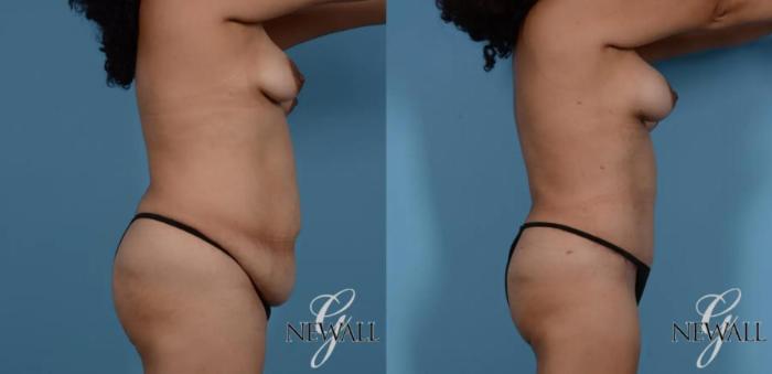 Before & After Tummy Tuck Case 16985 View 3 View in Houston, TX