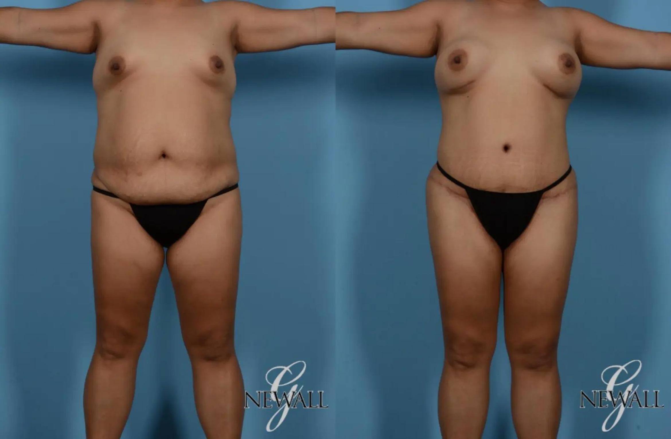 Before & After Tummy Tuck Case 16989 View 1 View in Houston, TX
