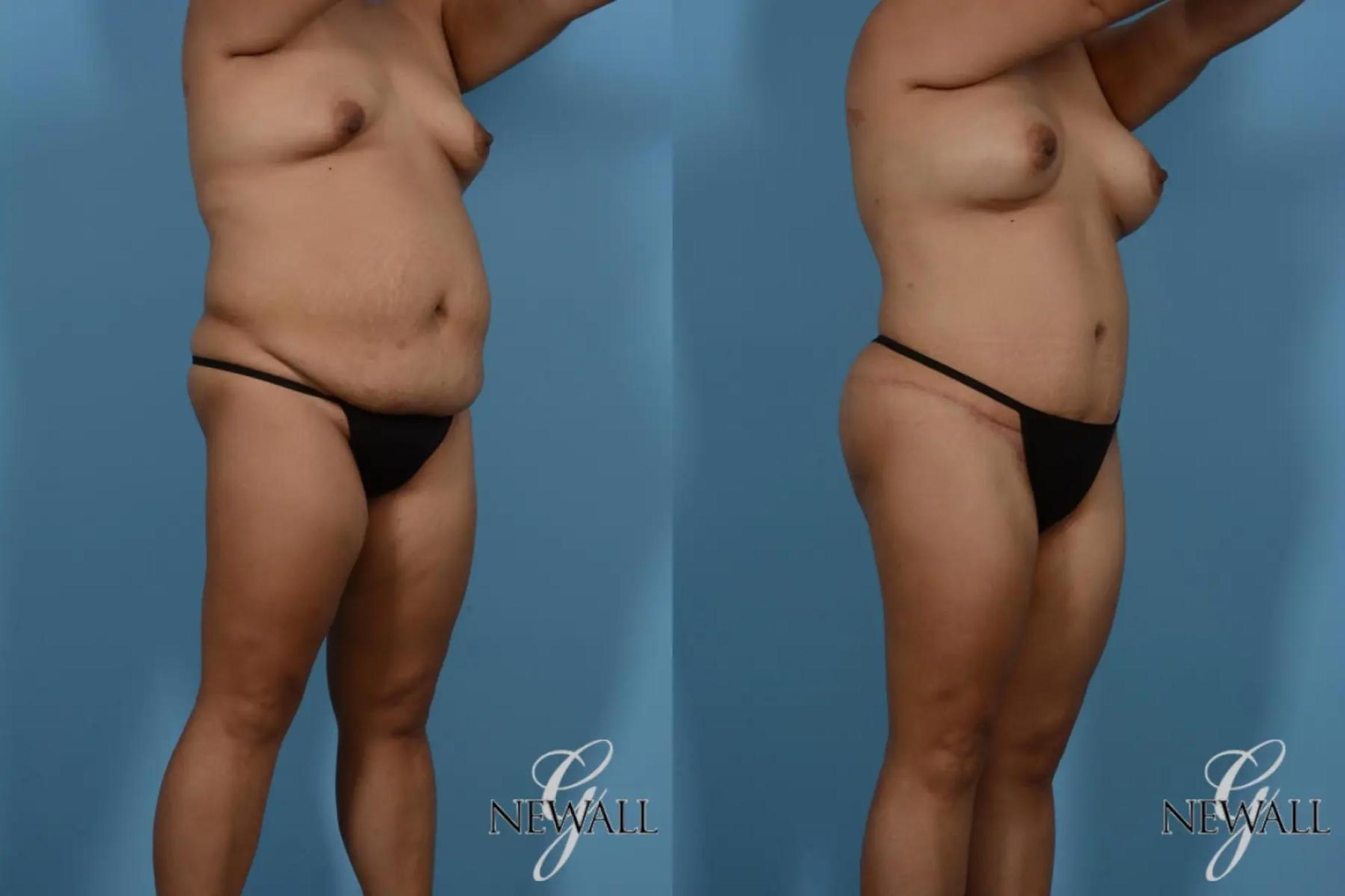 Before & After Tummy Tuck Case 16989 View 2 View in Houston, TX