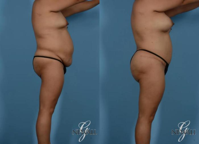 Before & After Tummy Tuck Case 16989 View 3 View in Houston, TX