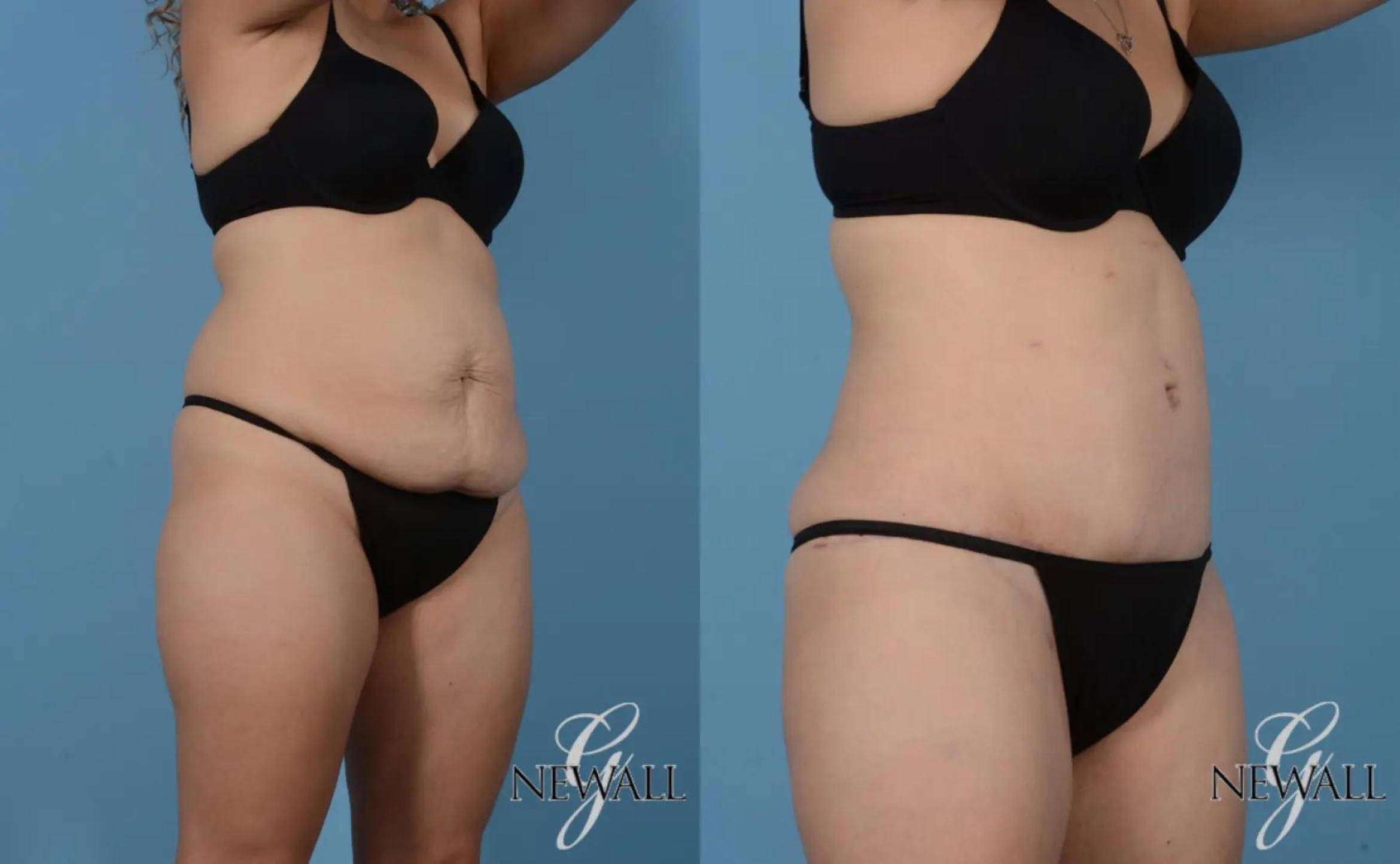 Before & After Tummy Tuck Case 16992 View 2 View in Houston, TX