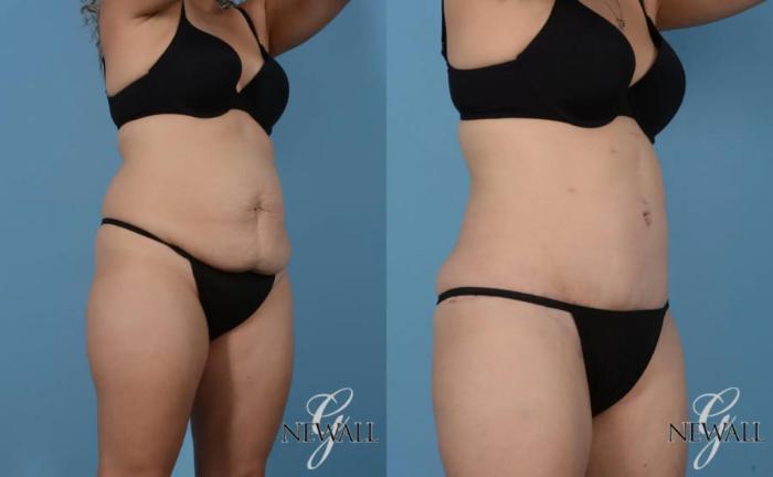 Before & After Tummy Tuck Case 16992 View 2 View in Houston, TX