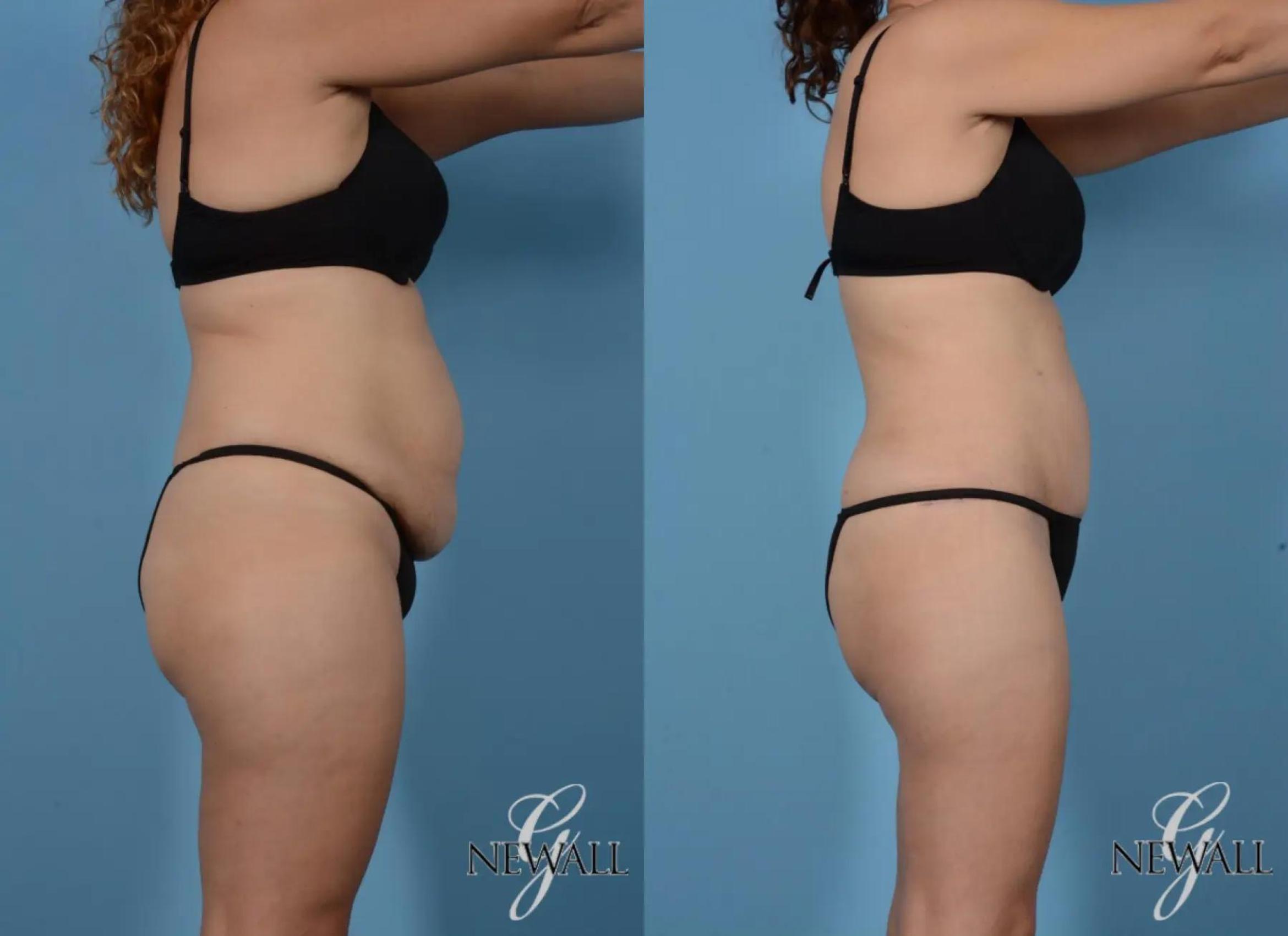 Before & After Tummy Tuck Case 16992 View 3 View in Houston, TX