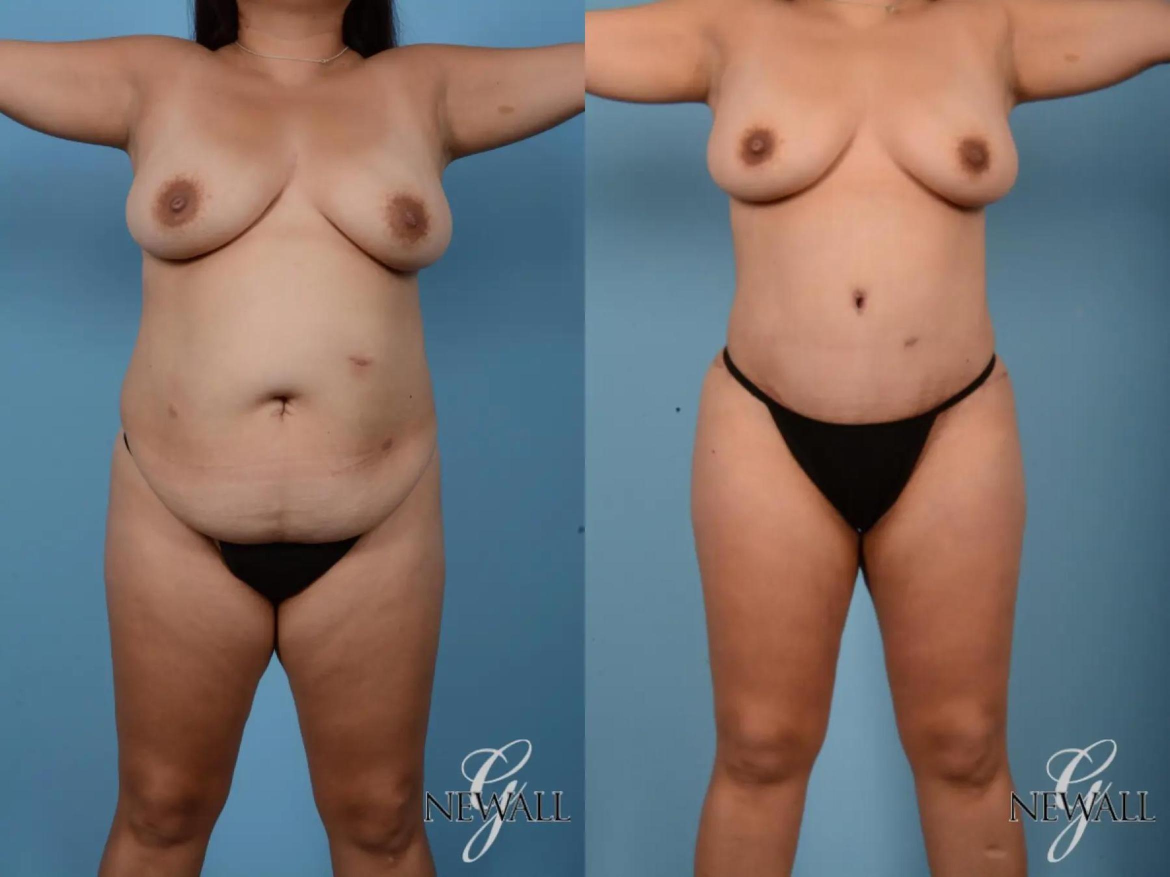 Before & After Tummy Tuck Case 16994 View 1 View in Houston, TX