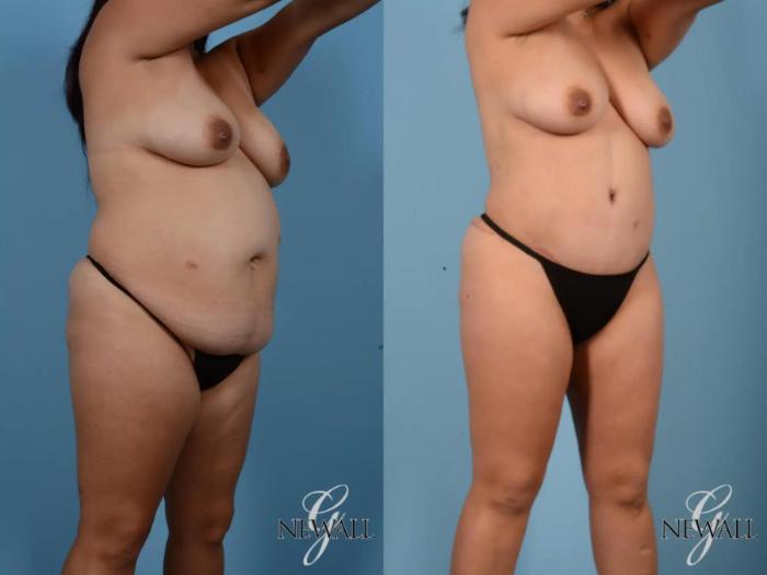 Before & After Tummy Tuck Case 16994 View 2 View in Houston, TX
