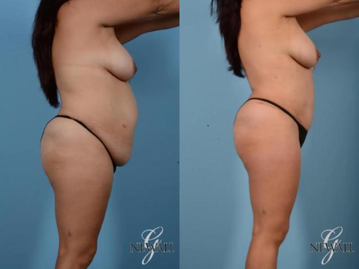 Before & After Tummy Tuck Case 16994 View 3 View in Houston, TX