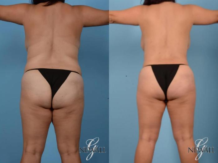 Before & After Tummy Tuck Case 16994 View 4 View in Houston, TX