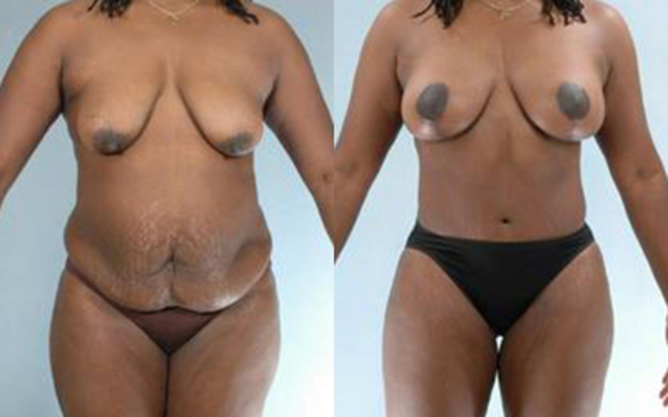 Before & After Tummy Tuck Case 17 View 1 View in Houston, TX