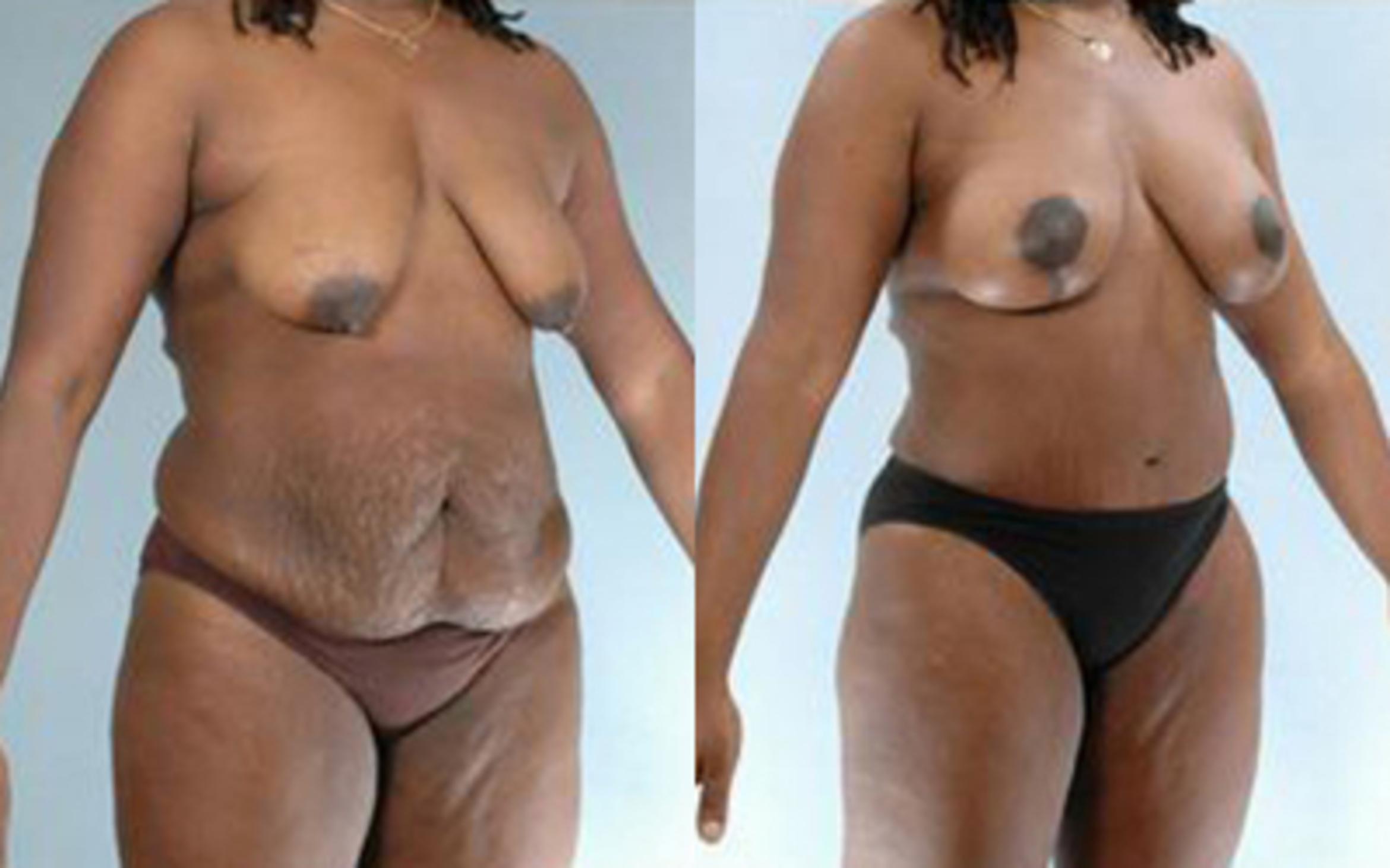 Before & After Tummy Tuck Case 17 View 2 View in Houston, TX