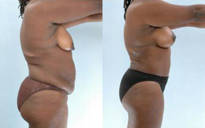 Before & After Tummy Tuck Case 17 View 3 View in Houston, TX