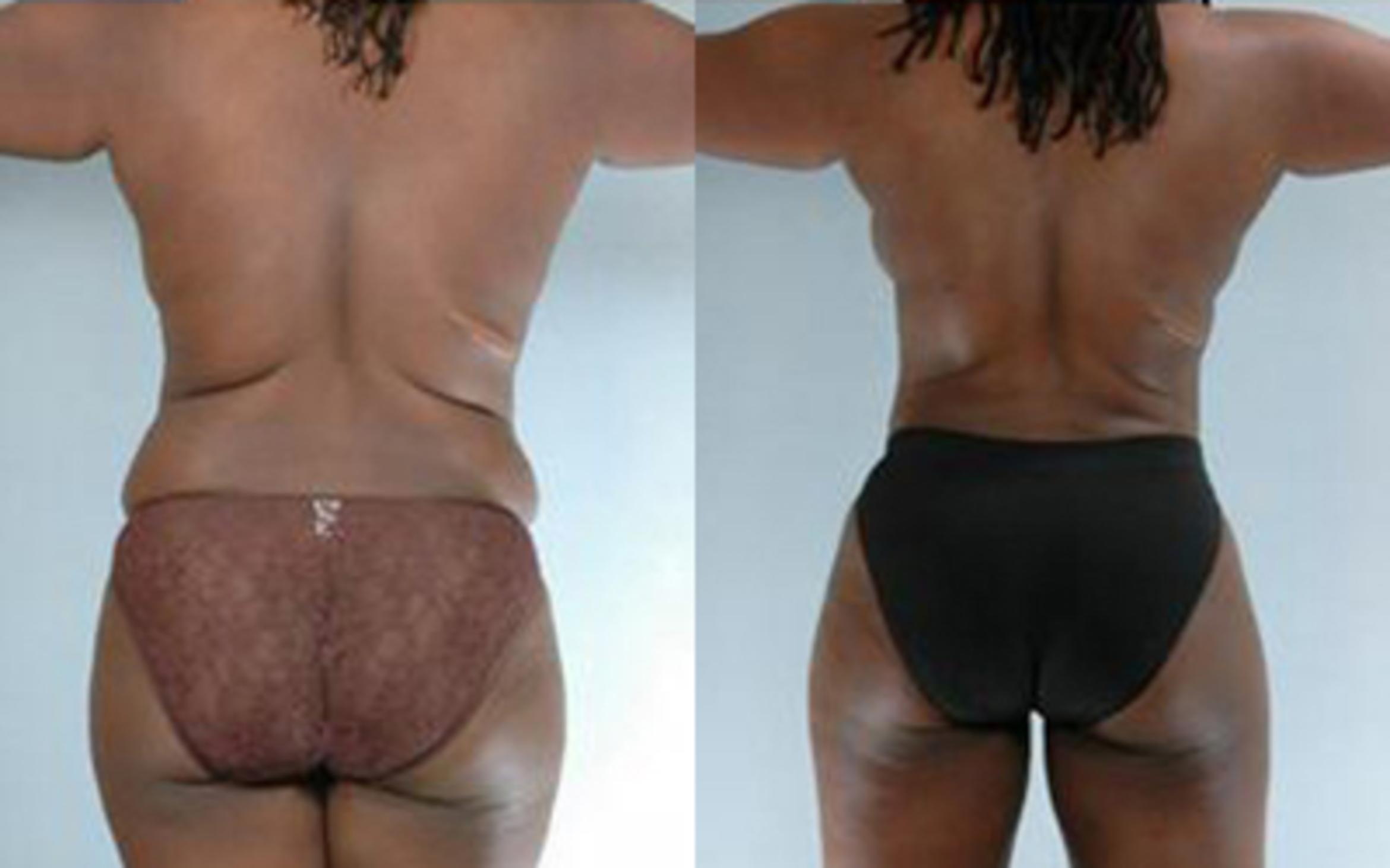 Before & After Tummy Tuck Case 17 View 4 View in Houston, TX