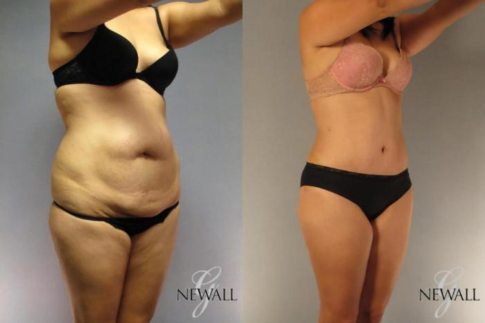 Before & After Tummy Tuck Case 17023 View 2 View in Houston, TX