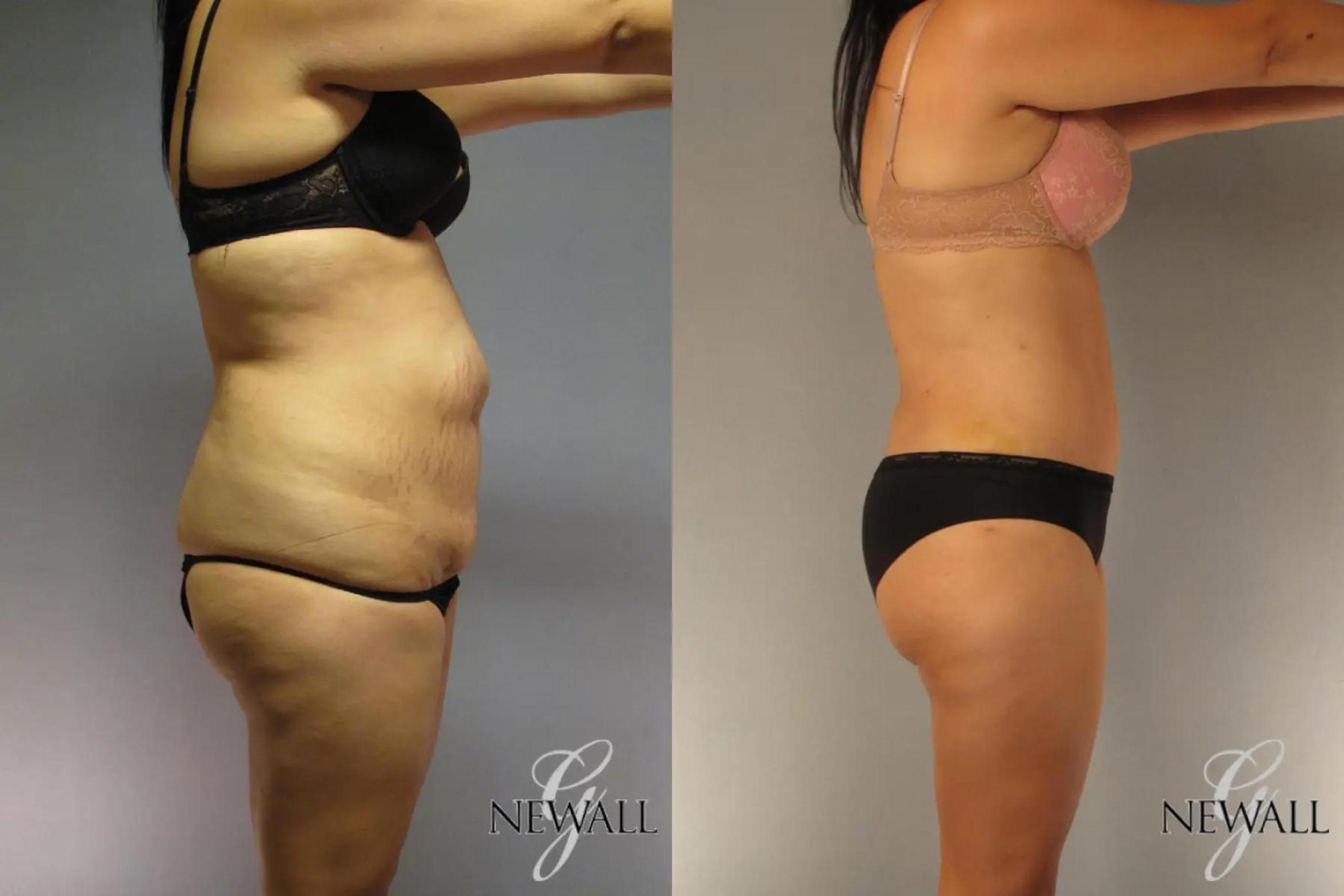 Before & After Tummy Tuck Case 17023 View 3 View in Houston, TX