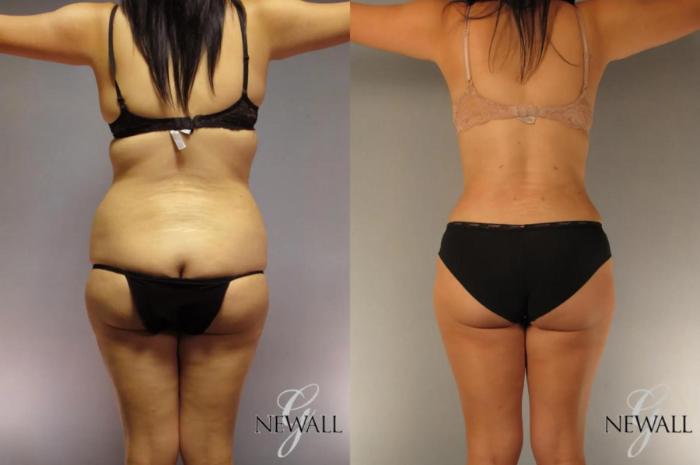 Before & After Tummy Tuck Case 17023 View 4 View in Houston, TX