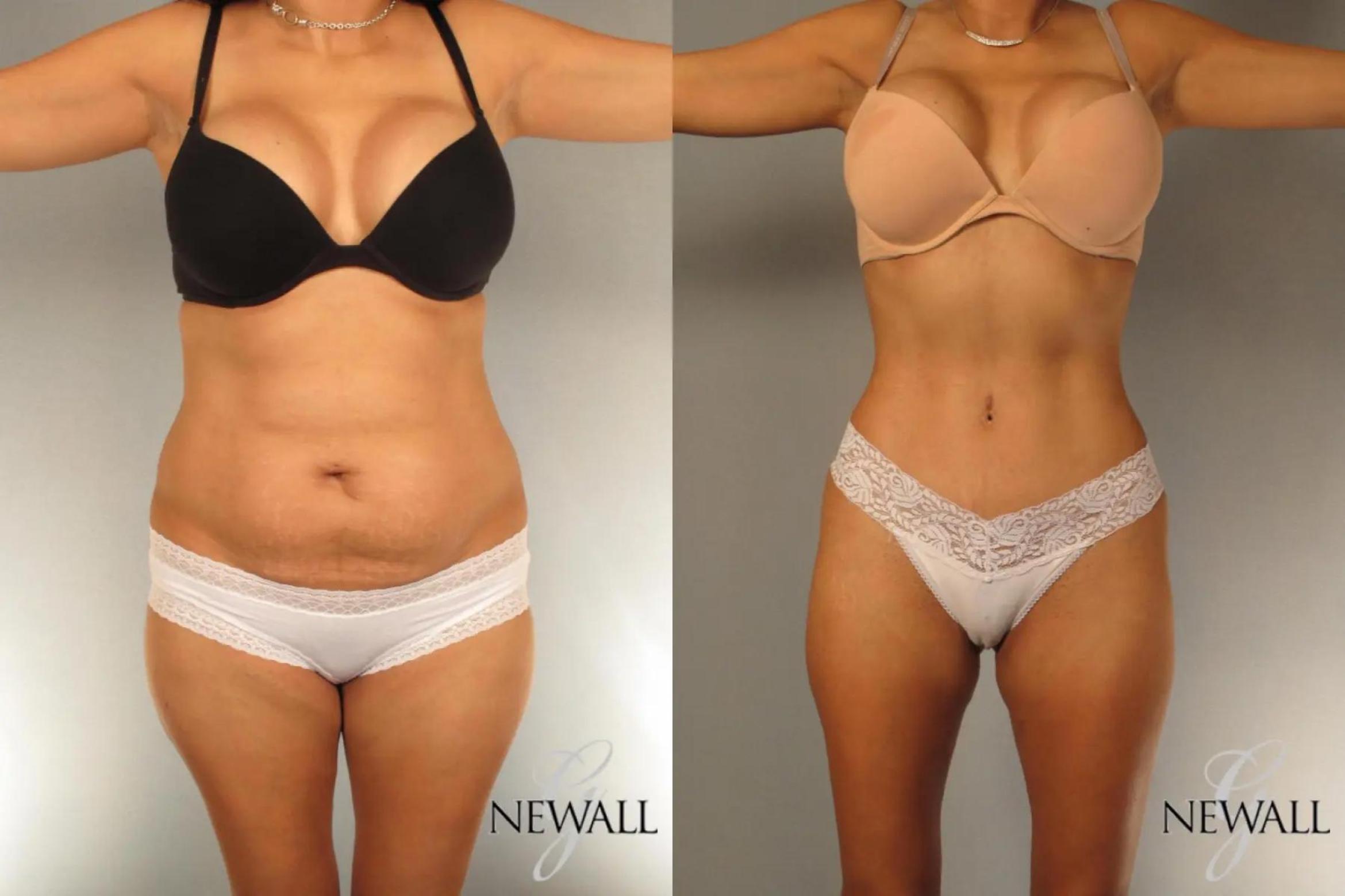 Before & After Tummy Tuck Case 17024 View 1 View in Houston, TX