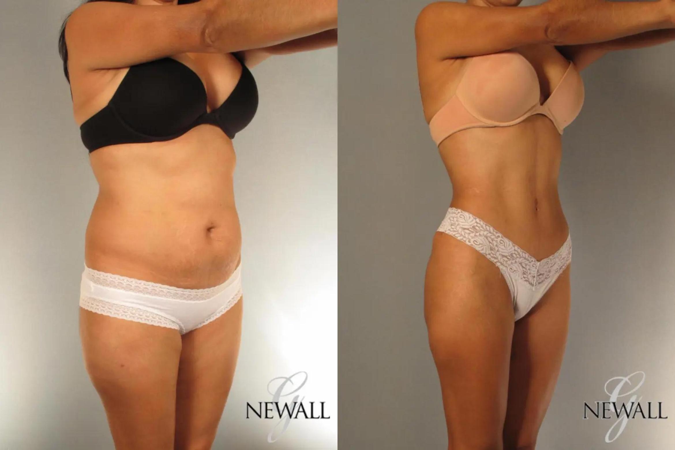 Before & After Tummy Tuck Case 17024 View 2 View in Houston, TX