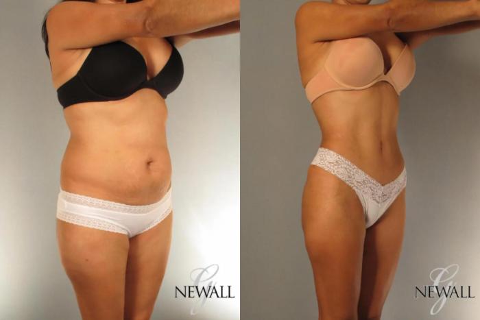 Before & After Tummy Tuck Case 17024 View 2 View in Houston, TX
