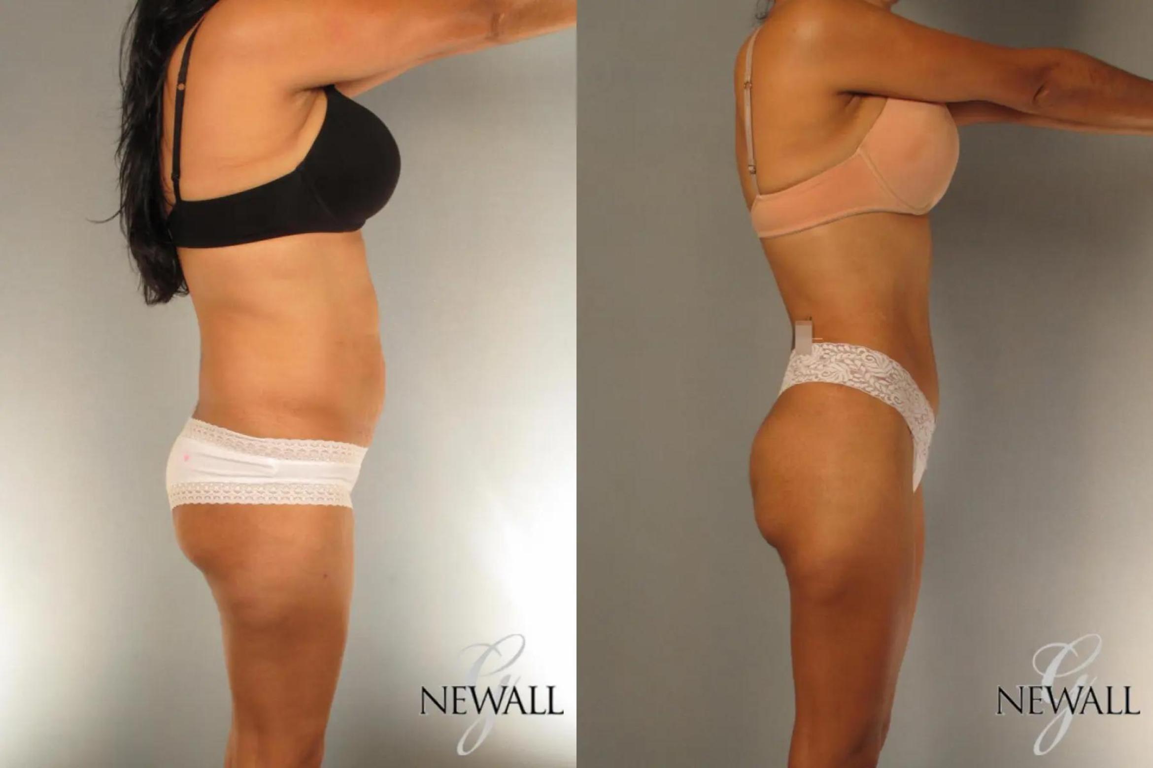 Before & After Tummy Tuck Case 17024 View 3 View in Houston, TX
