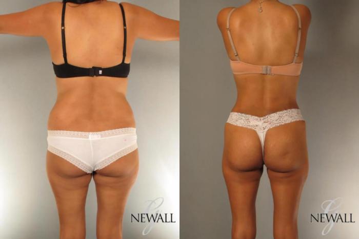 Before & After Tummy Tuck Case 17024 View 4 View in Houston, TX