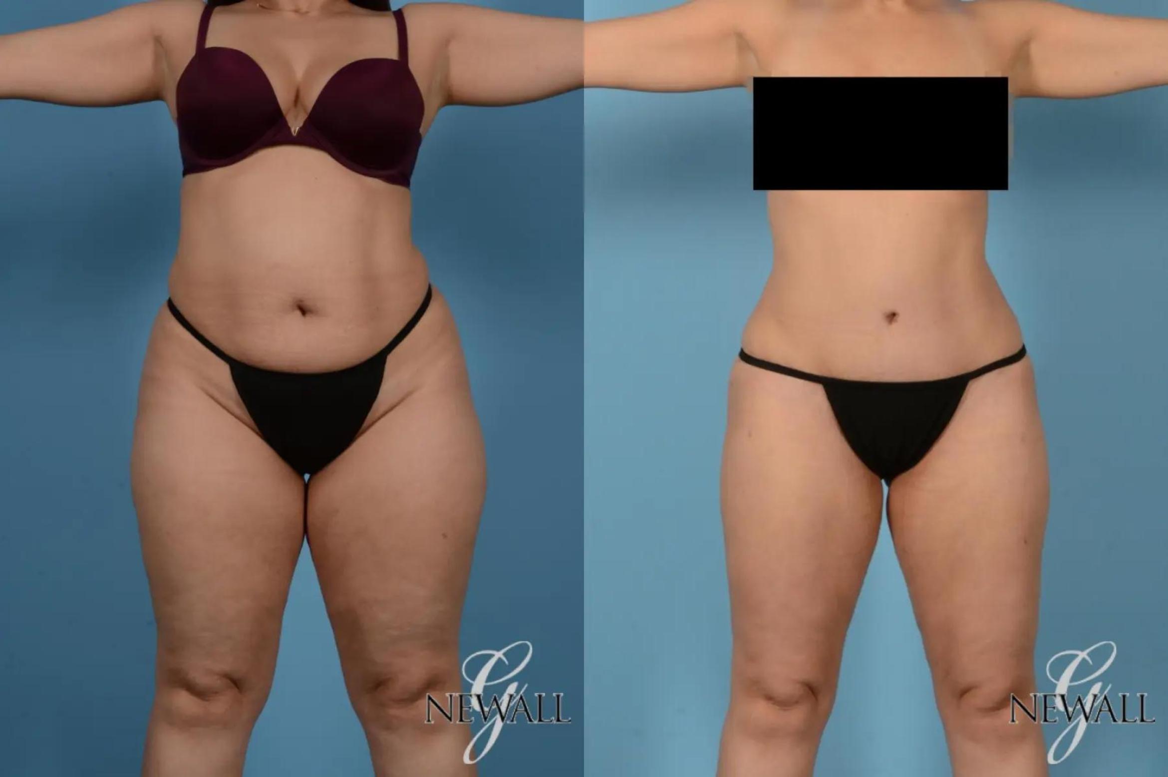 Before & After Tummy Tuck Case 17167 View 1 View in Houston, TX