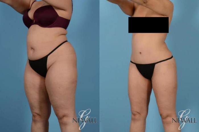 Before & After Tummy Tuck Case 17167 View 2 View in Houston, TX
