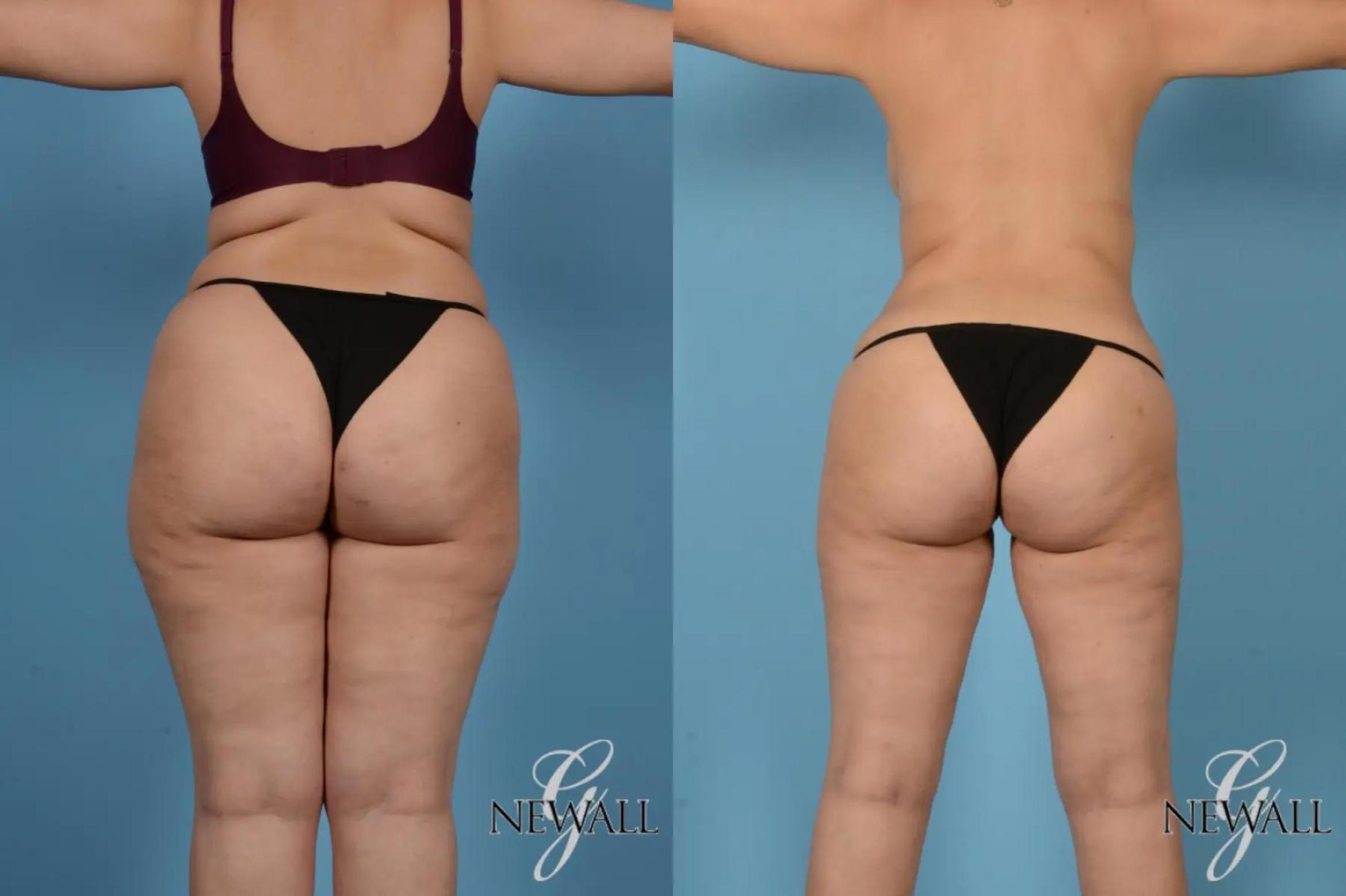 Before & After Tummy Tuck Case 17167 View 3 View in Houston, TX