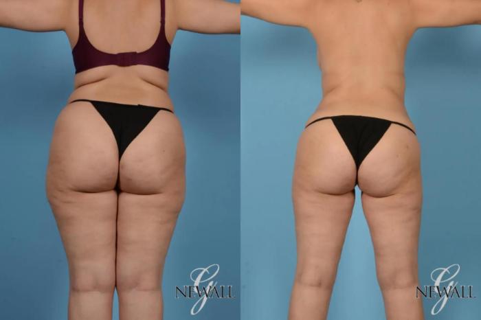 Before & After Tummy Tuck Case 17167 View 3 View in Houston, TX