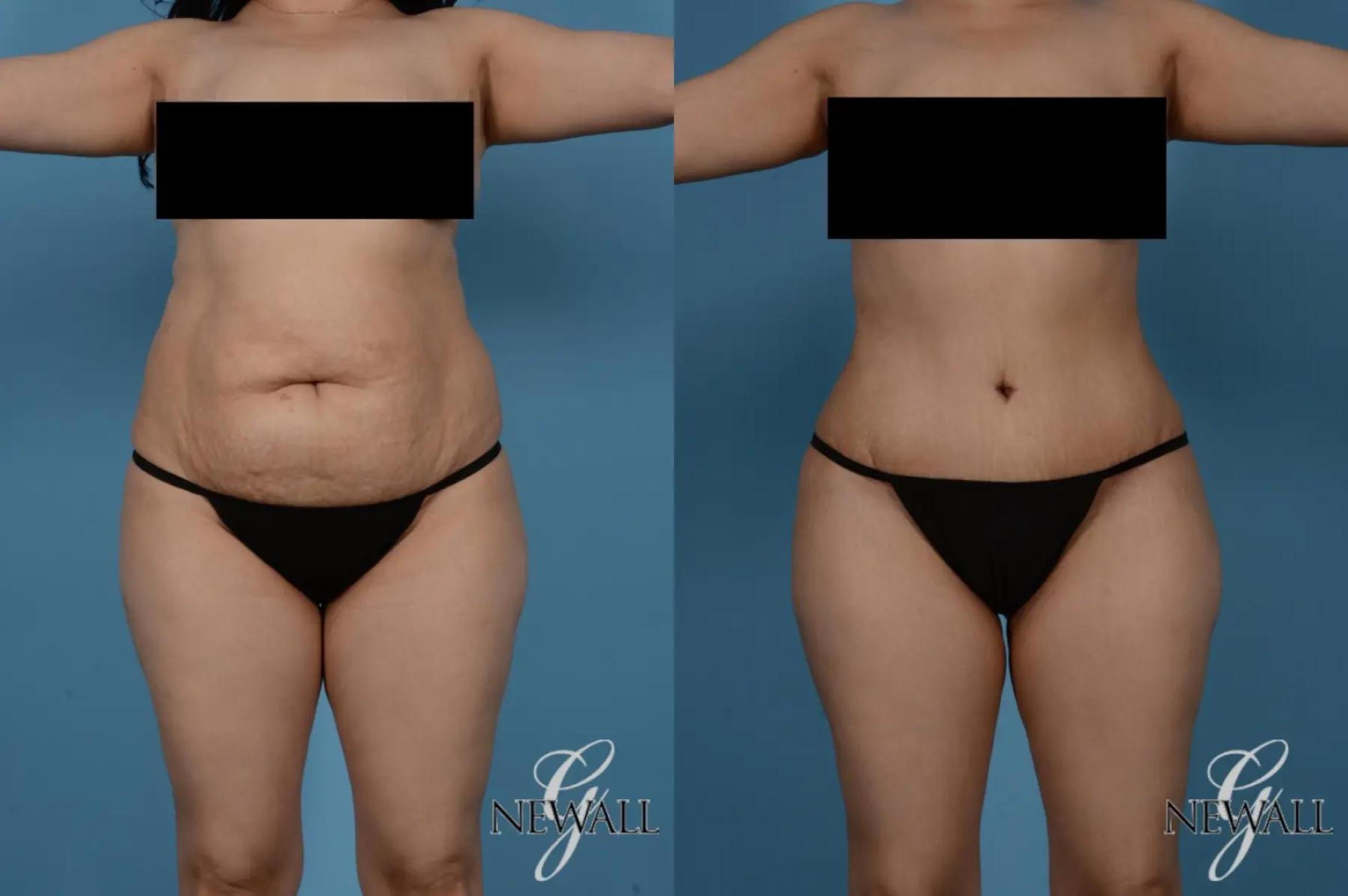 Before & After Tummy Tuck Case 17363 View 1 View in Houston, TX