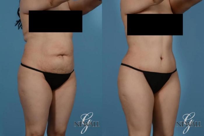 Before & After Tummy Tuck Case 17363 View 2 View in Houston, TX